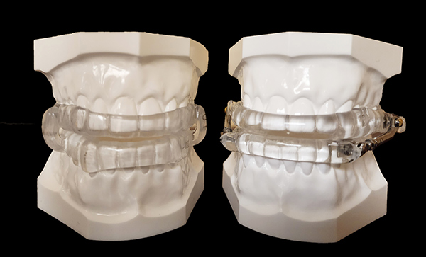 Oral Appliance Therapy (OAT)